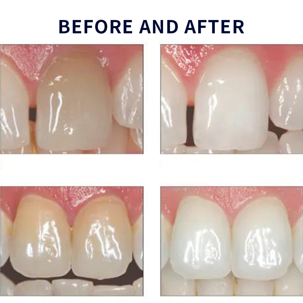 Opalescence Whitening 20% PF 2 - Teeth Whitening In Office ulasan dan harga