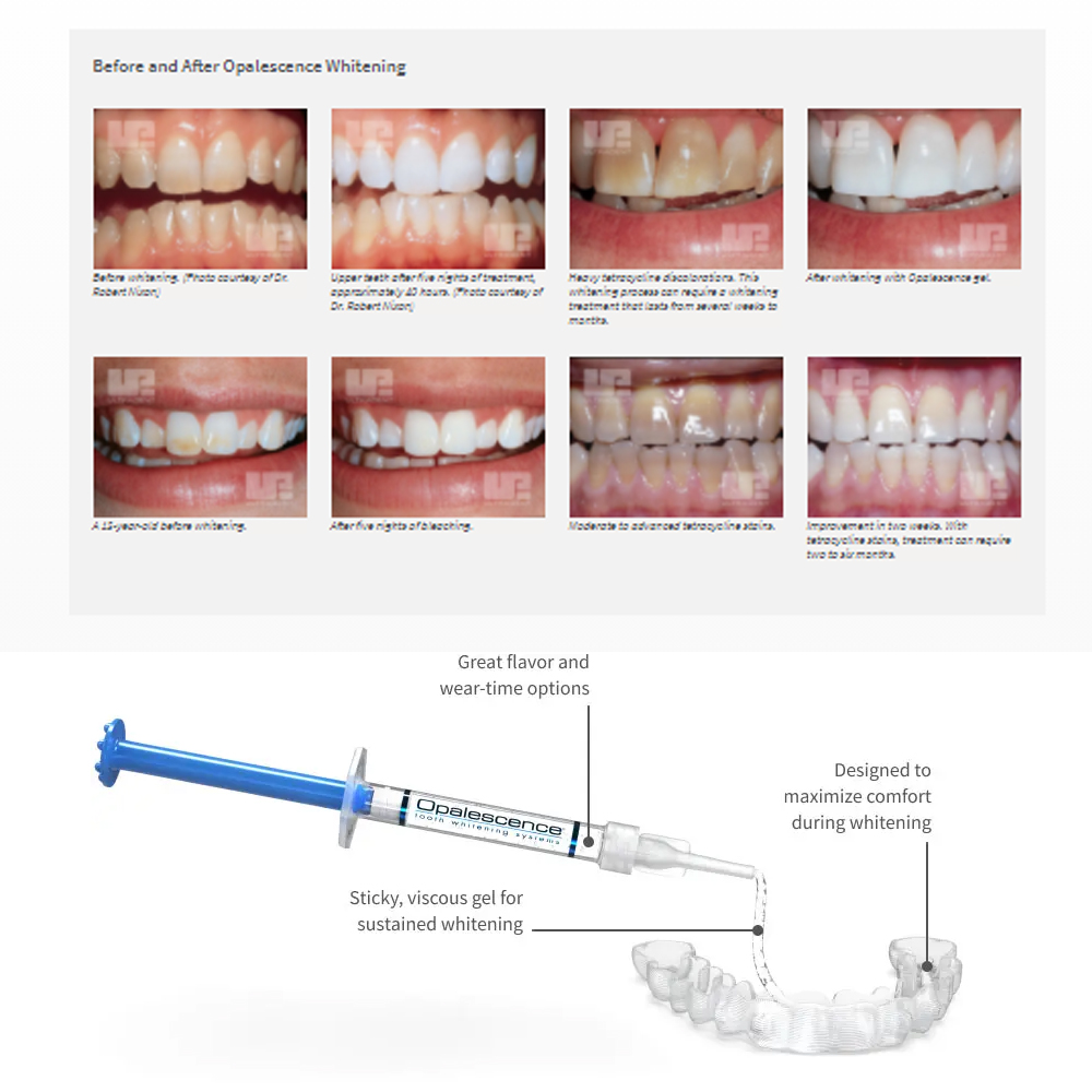 Opalescence Whitening 20% PF 2 - Teeth Whitening In Office ulasan dan harga