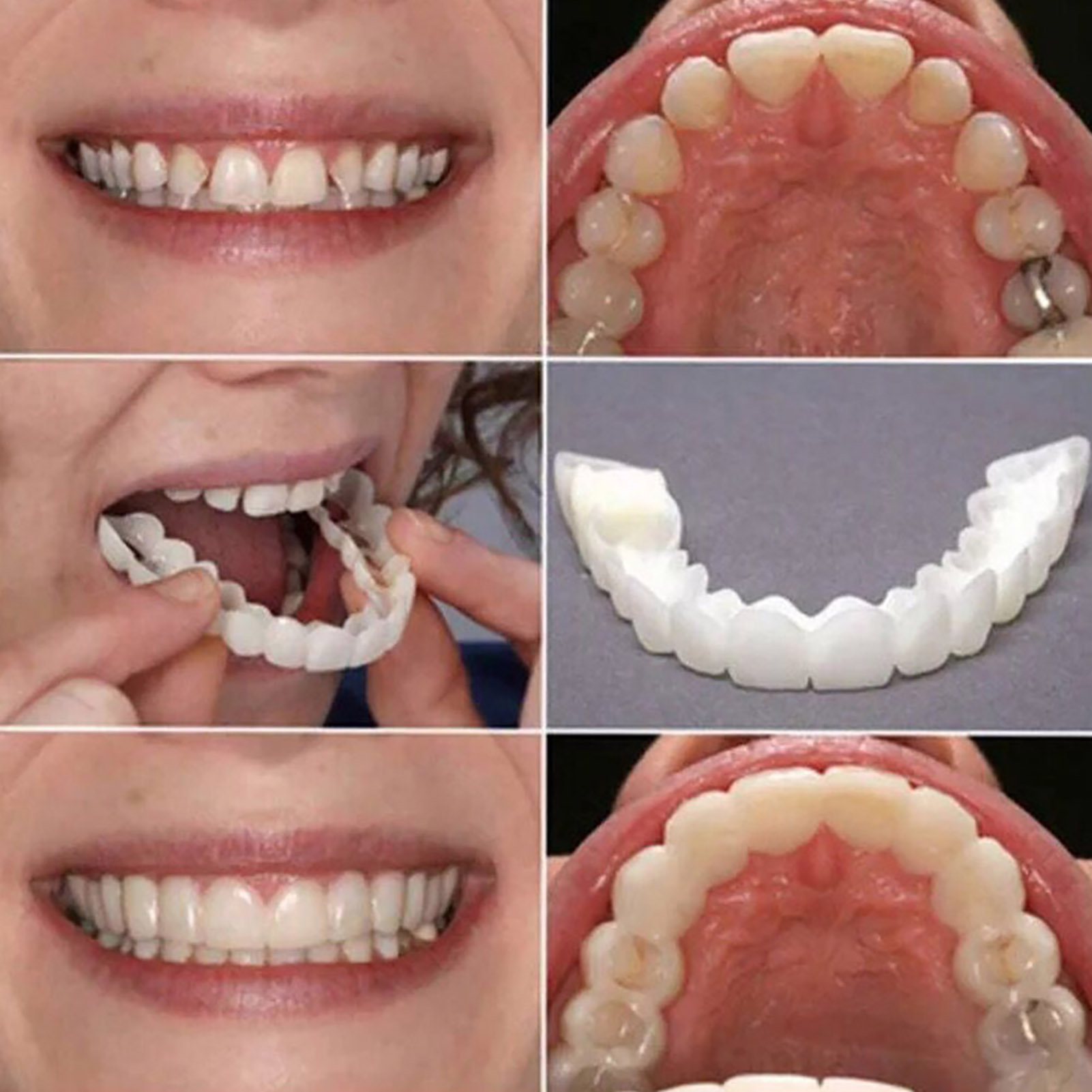 Daily Commute Teeth Veneers, T - Teeth Whitening In Office ulasan dan harga